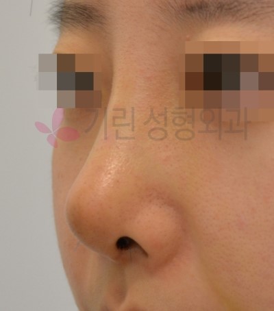 코재수술잘하는곳 : 보형물이 비치는 경우 관련 이미지 2