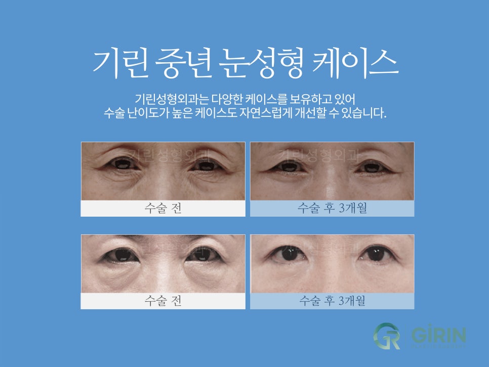상하안검 주름 고민이 있다면 관련 이미지 2