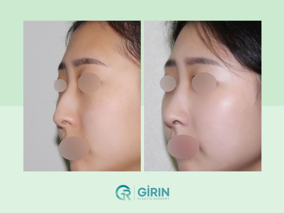 비염코성형 실비 가능성 있기에 관련 이미지 5