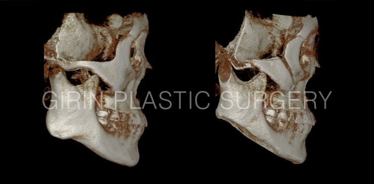 광대고정, 긴곡선절제(넓은턱) 케이스 관련 이미지 2