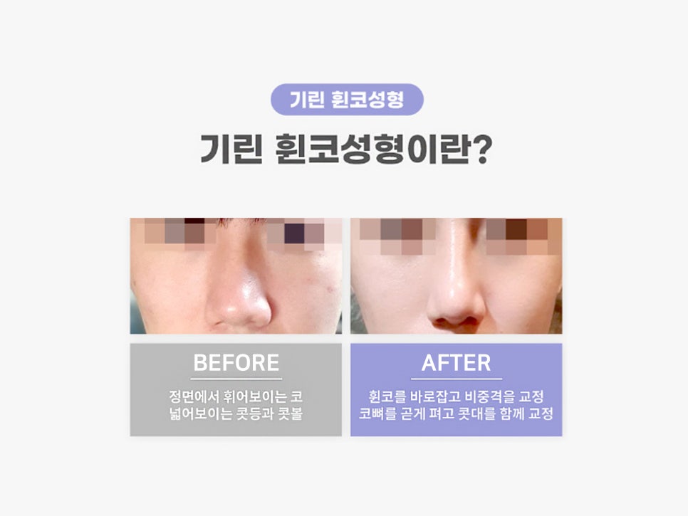 휜코성형잘하는곳 꼼꼼하게 따져보자 관련 이미지 6