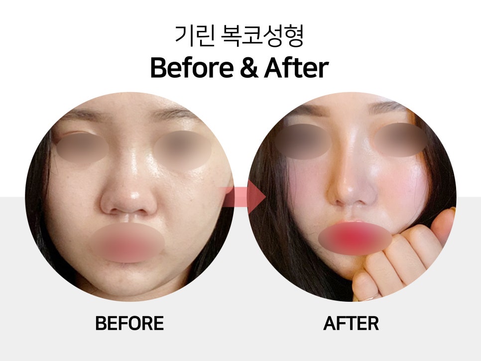 복코수술전후 이미지가 달라지는 관련 이미지 2