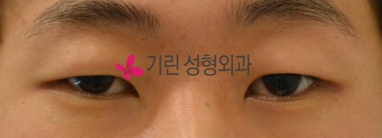 쌍꺼풀수술비용과 전후 관련 이미지 1