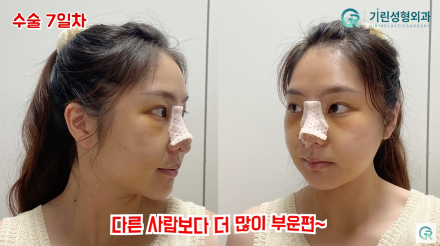[기린성형외과의원] "카리나가 되고싶어요"_안면윤곽 수술일지 관련 이미지 9