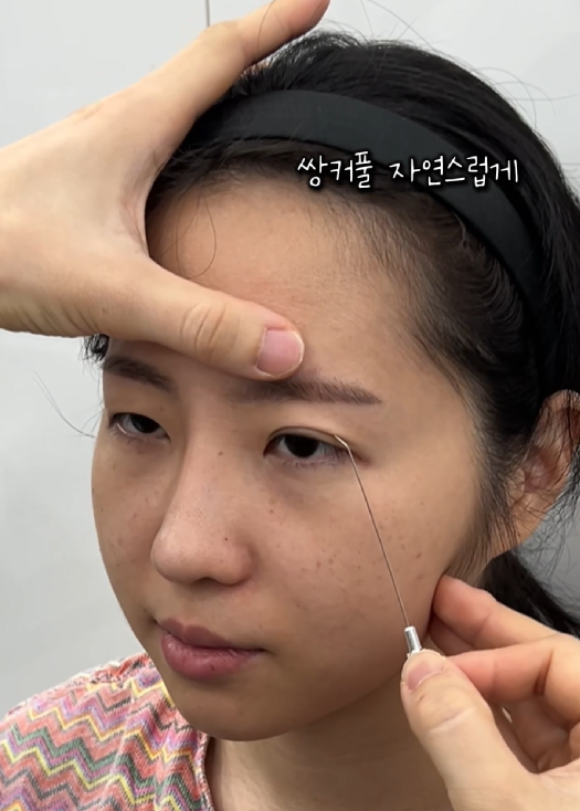 강남역 근처 쌍꺼풀 잘하는 곳 어디? 생생한 후기 관련 이미지 5