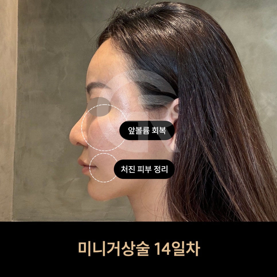 위고비&middot;마운자로 후 얼굴처짐으로 인한 미니거상 후기 관련 이미지 7