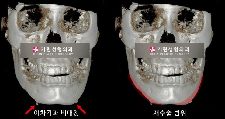 안면윤곽재수술 시 고려해야 할 점 관련 이미지 6