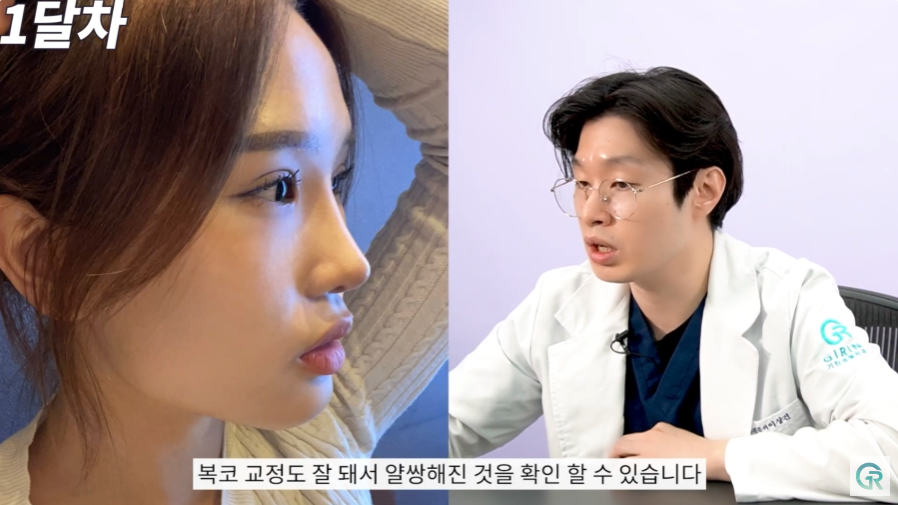 [기린성형외과] 작고 답답한 눈, 뭉뚝하고 낮은 복코 탈출!_눈성형, 코성형 수술일지 관련 이미지 10