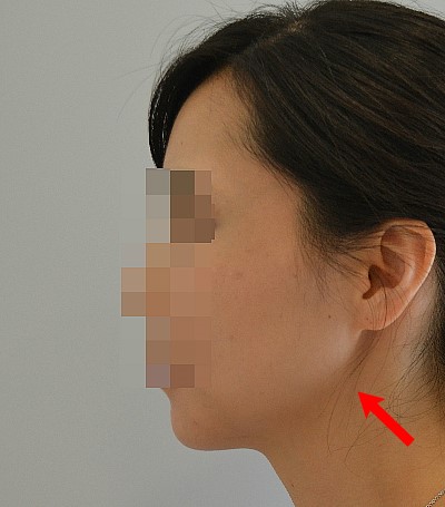 뉴브이라인수술로 귀밑각부터 턱끝까지 절골한 경우(하악각제거범위) 관련 이미지 2