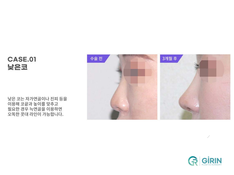 무보형물 코성형 안전하게 잘하는 곳 관련 이미지 7