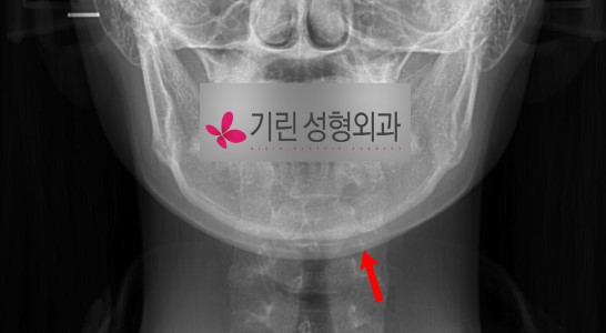사각턱수술 후 어디까지 잘라냈는지 엑스레이를 보고 알 수 있을까? (피질골절제술 시행여부 판단방법) 관련 이미지 1