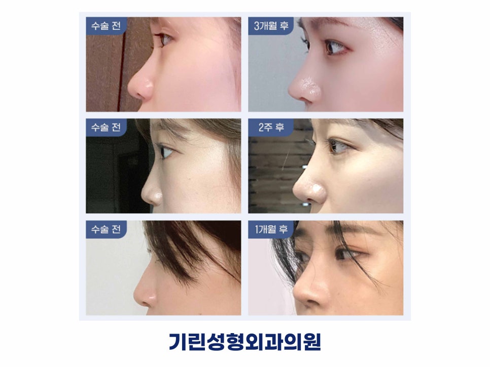 강남역성형외과유명한곳 얼굴에 맞춰 조화롭게 관련 이미지 2