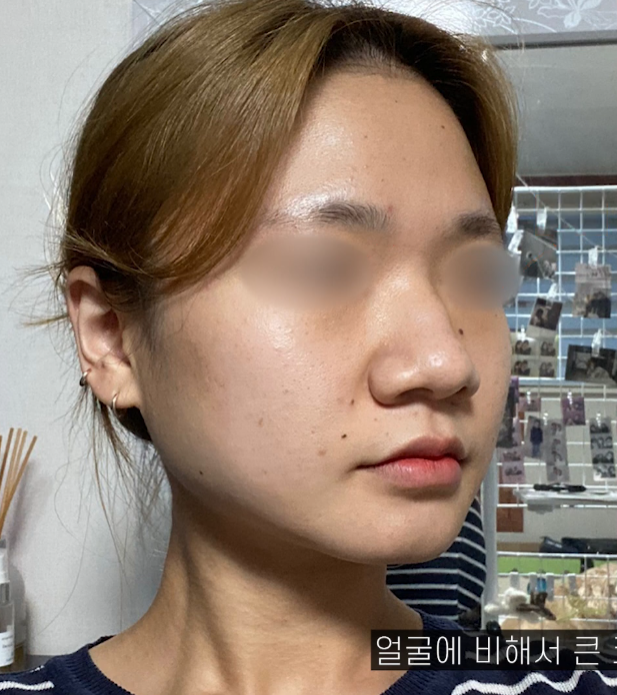 [기린성형외과의원] 코끝과 콧볼 교정으로 얄쌍해진 코_복코성형 수술일지 관련 이미지 2