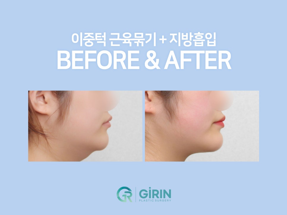 이중턱지방흡입 하나로 어렵다면? 관련 이미지 6
