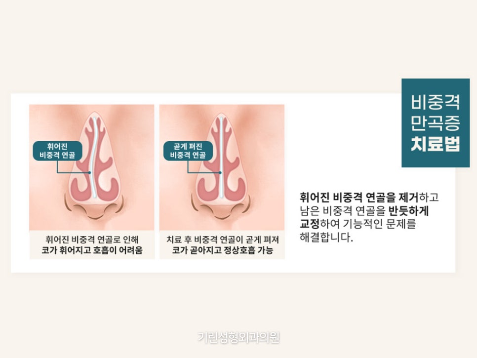 비중격만곡증코성형 같이 진행하고 싶으면 관련 이미지 7