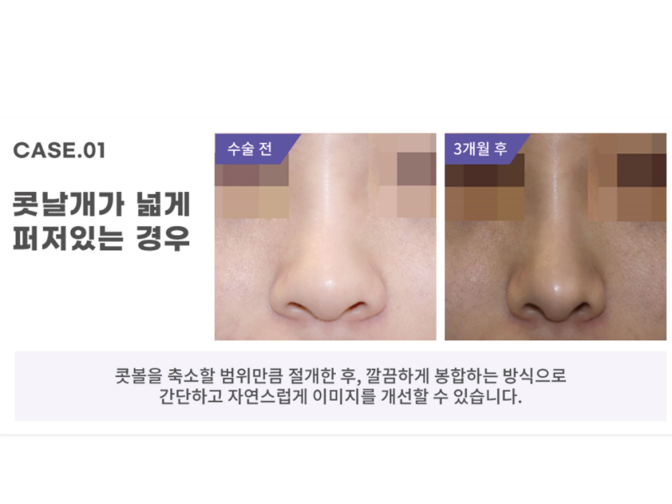콧볼축소술 세련된 인상을 원한다면 관련 이미지 10