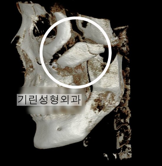 광대볼처짐의 원인인 광대체부의 이동 관련 이미지 1