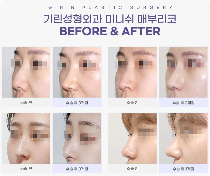 매부리코수술후기, 별로 도움 안 된다? 관련 이미지 5