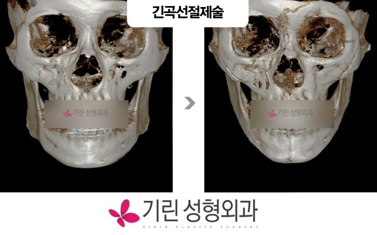 CT로 보는 사각턱수술 정면효과 관련 이미지 1
