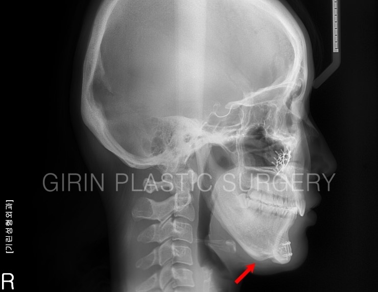 티절골 후 이차각으로 재수술이 필요한 사례 관련 이미지 2