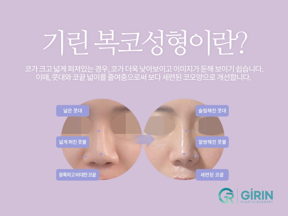 복코성형후기 세련미 있는 코 원한다면 관련 이미지 4