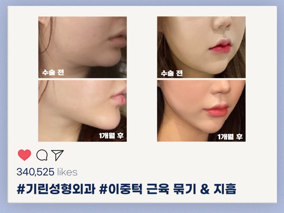 이중턱지흡 생각한다면 관련 이미지 4