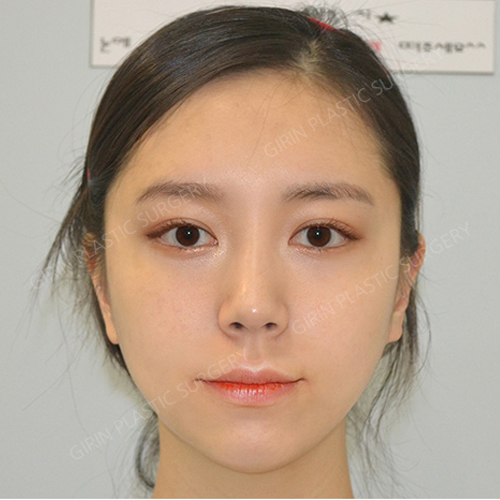 요즘 누가 티나게 성형하니? 기린성형외과 자연유착으로 미모완성♥(+후기) 관련 이미지 3