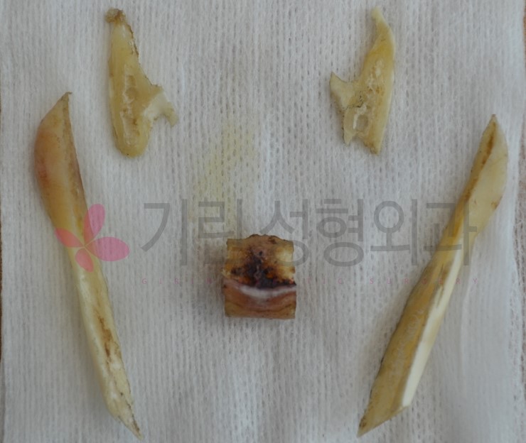 넓은앞턱 줄이기 위한 앞턱수술 [앞턱수술후 뼈_bone] 관련 이미지 1