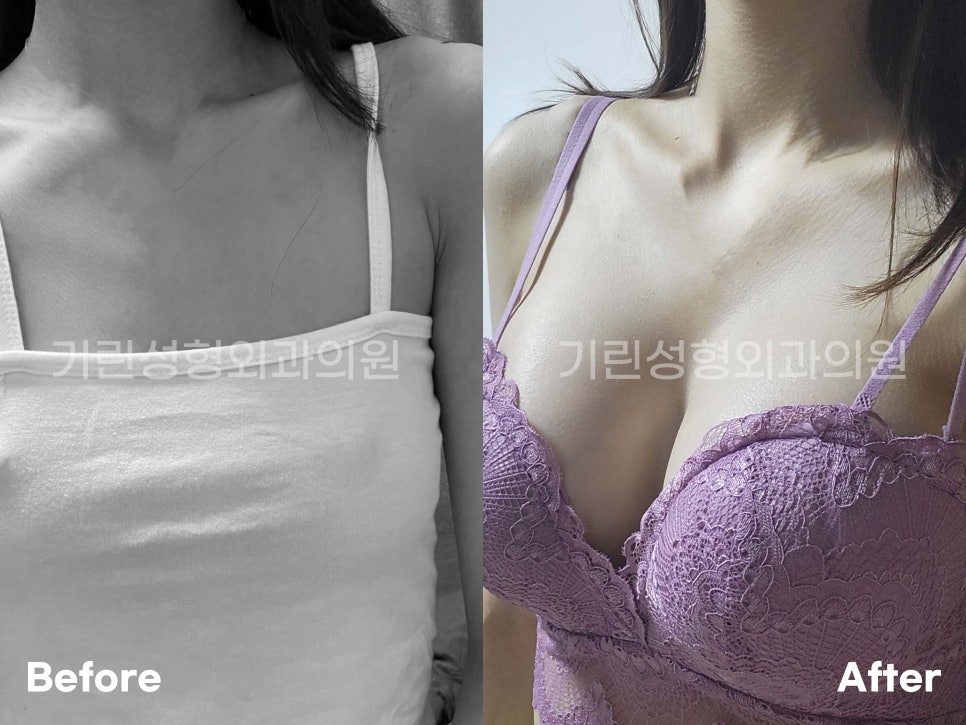 가슴확대수술전후 개선한 모습 궁금하다면 관련 이미지 15