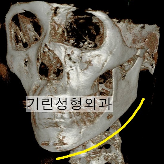앞턱 끝까지 자르는 긴곡선절제술 (전후CT) 관련 이미지 2