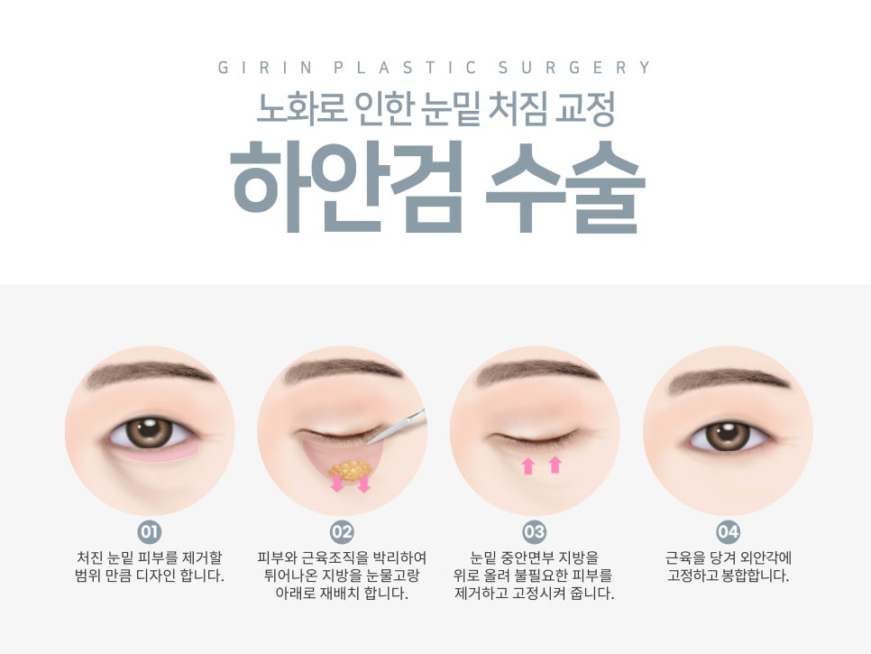 강남눈성형 눈매 개선 만족스럽게 관련 이미지 7