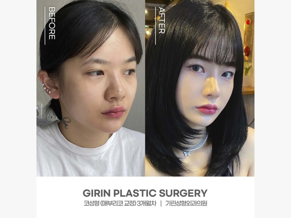 매부리코수술후기 올바른 라인으로 관련 이미지 6