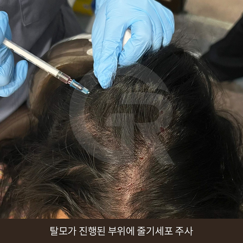 탈모 고민 두피 줄기세포 치료, 가격이 다른 이유는? 관련 이미지 9