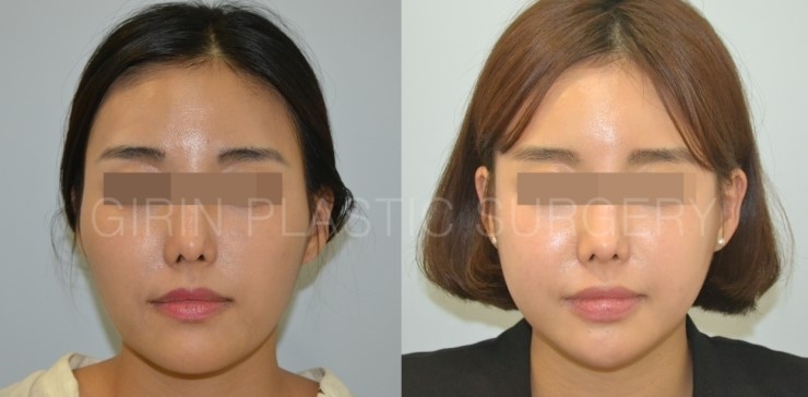 브이라인, 광대고정술 5개월경과 관련 이미지 1