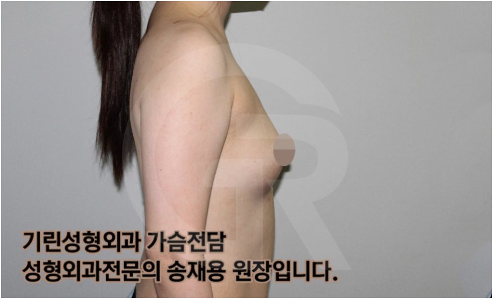 가슴확대수술 후 관리방법, 실제사례 알아보다. [기린성형외과의원_Dr.송재용] 관련 이미지 3