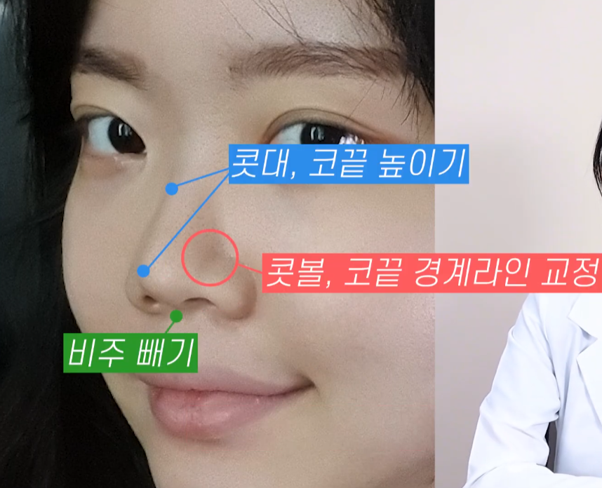 [기린성형외과의원] 코성형 전 코필러 하셨나요?_작은 코성형 수술일지 관련 이미지 4