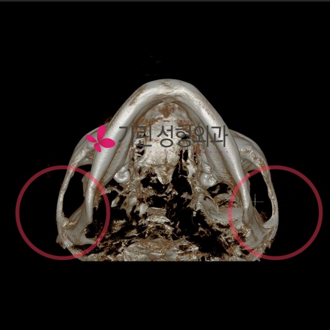 고정과 비고정이 광대축소술 후 부작용과 관련있을까 관련 이미지 1