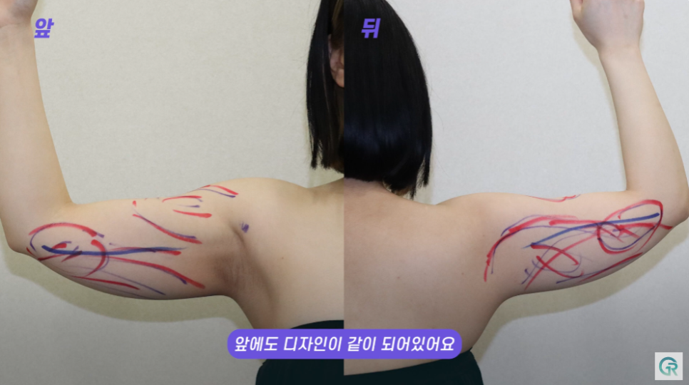 [기린성형외과] 뼈 팔뚝 된 비결 알려줄게_팔뚝 지방흡입 수술일지 관련 이미지 7
