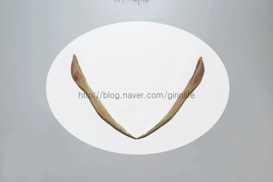 티절골은 어떤 수술일까 (수술후bone) 관련 이미지 3