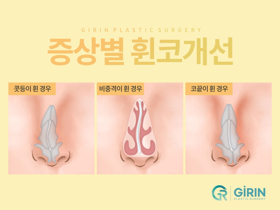 여자코성형 원하는 라인 고려하여 관련 이미지 5