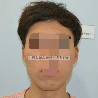 남자긴턱줄임+자가뼈앞턱수술+광대고정 수술다음날CT 관련 이미지 1