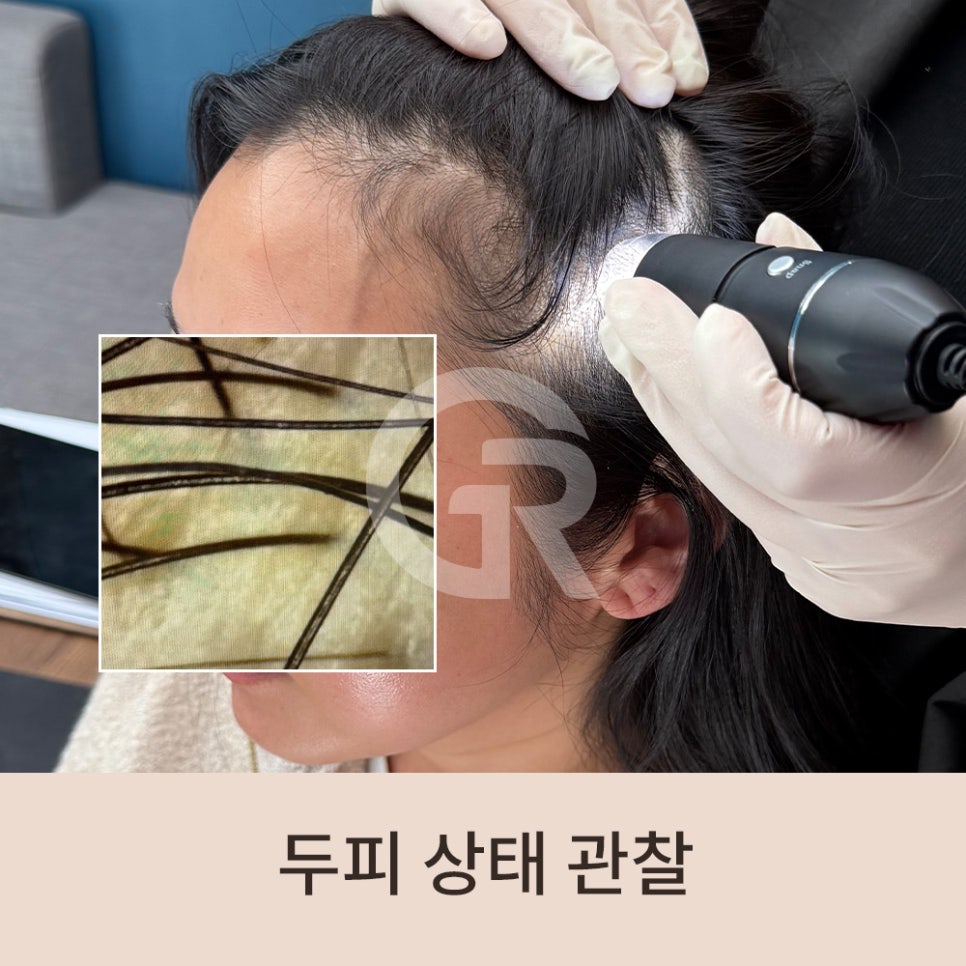 "머리숱이 없어요" 가르마 탈모 환자 줄기세포 주사 관련 이미지 3