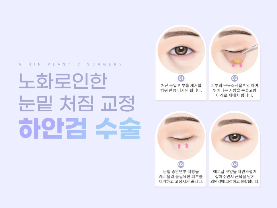 하안검수술잘하는곳 주름이 고민이라면 관련 이미지 7