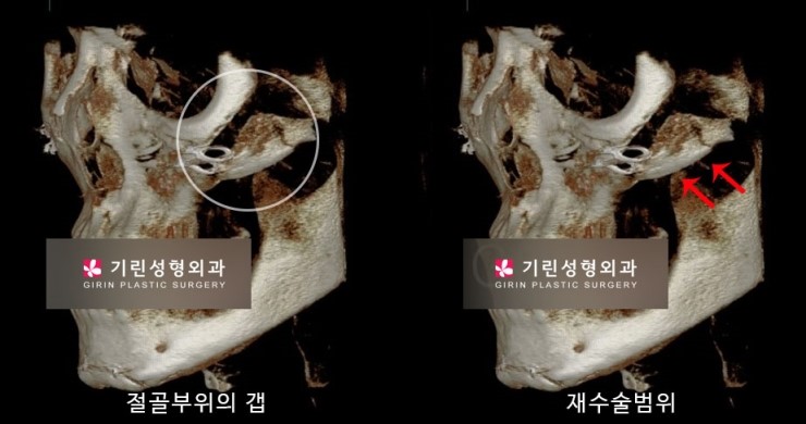 안면윤곽재수술 시 고려해야 할 점 관련 이미지 11