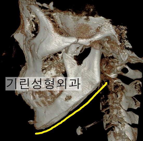 앞턱 끝까지 자르는 긴곡선절제술 (전후CT) 관련 이미지 4