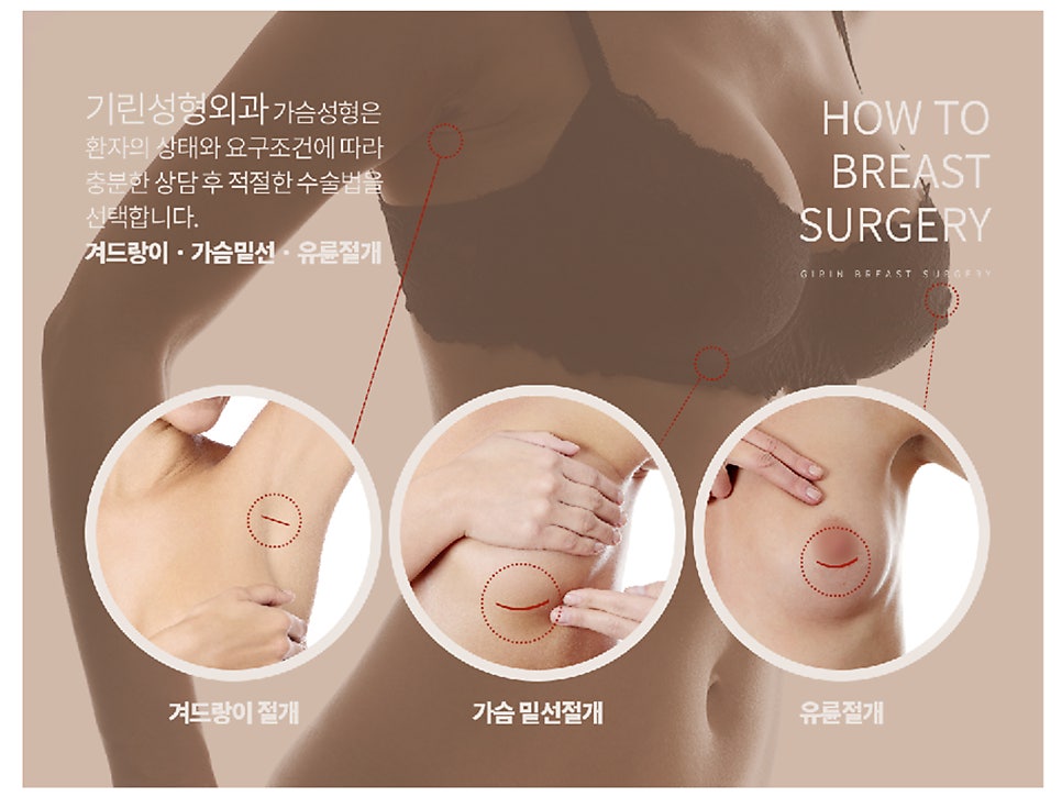 출산후 가슴수술 필요하다 느낀다면 관련 이미지 13