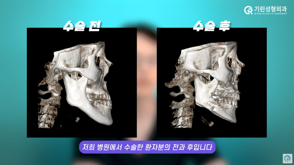 [기린성형외과의원] 눈, 코성형 전 필수 시청_얼굴형이 갖는 미적가치 관련 이미지 6