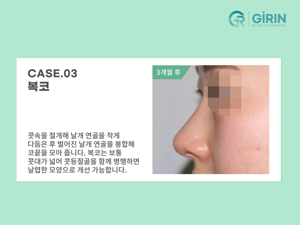 코성형 종류 비교하고 맞춰서 관련 이미지 11