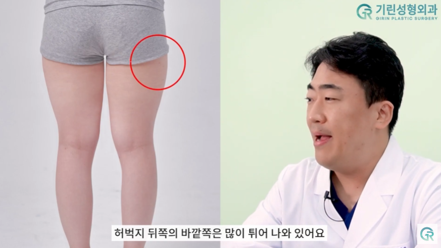 [기린성형외과의원] 뼈벅지?허틈!_허벅지지방흡입 수술일지 관련 이미지 5