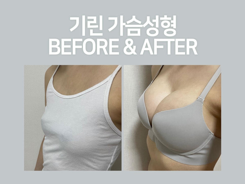 강남가슴성형 자연스러움이 기준 관련 이미지 7